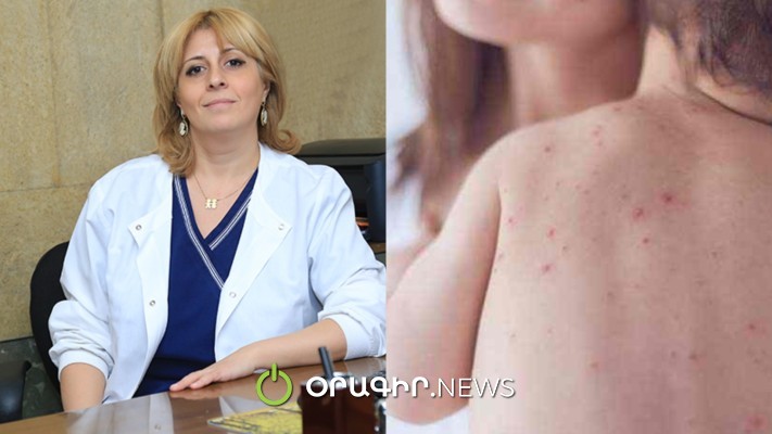 Չի բացառվում, որ կարմրուկի նոր բռնկում կլինի